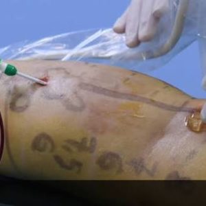 Chirurgie mini-invasive : quand privilégier le laser pour traiter les varices ?