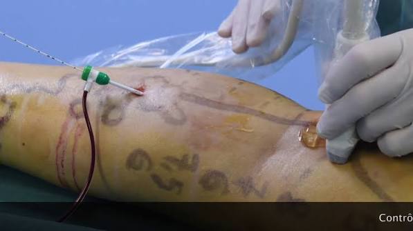 Chirurgie mini-invasive : quand privilégier le laser pour traiter les varices ?